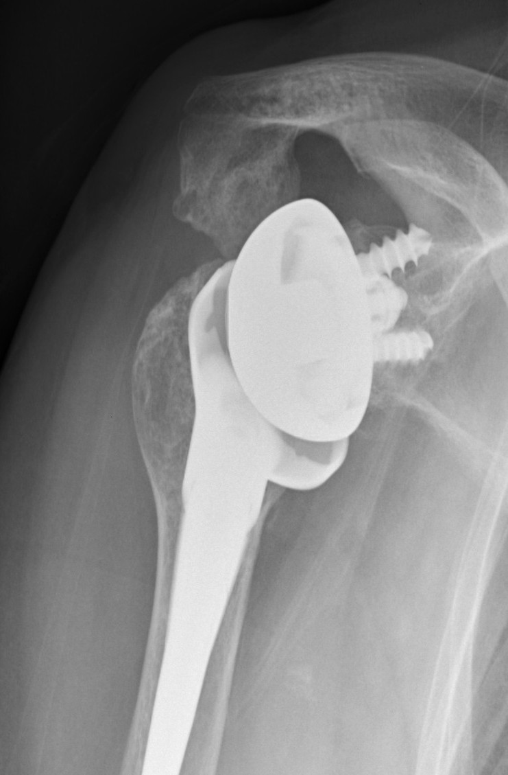 Xray Acromial Stress Fracture Reverse TSR